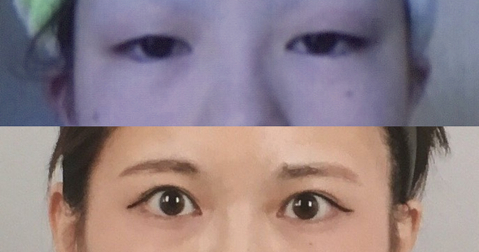 初めての整形手術。「三点留め埋没法」で二重まぶたにした話